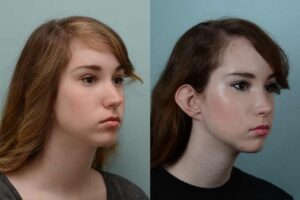 rhinoplasty in lahore