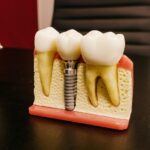 dental implants